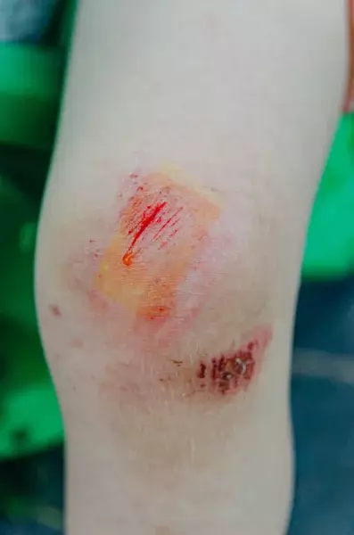 kaki lecet gambar lutut luka jatuh dari motor