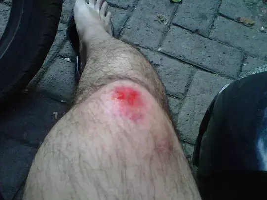 lecet lecet gambar lutut luka jatuh dari motor